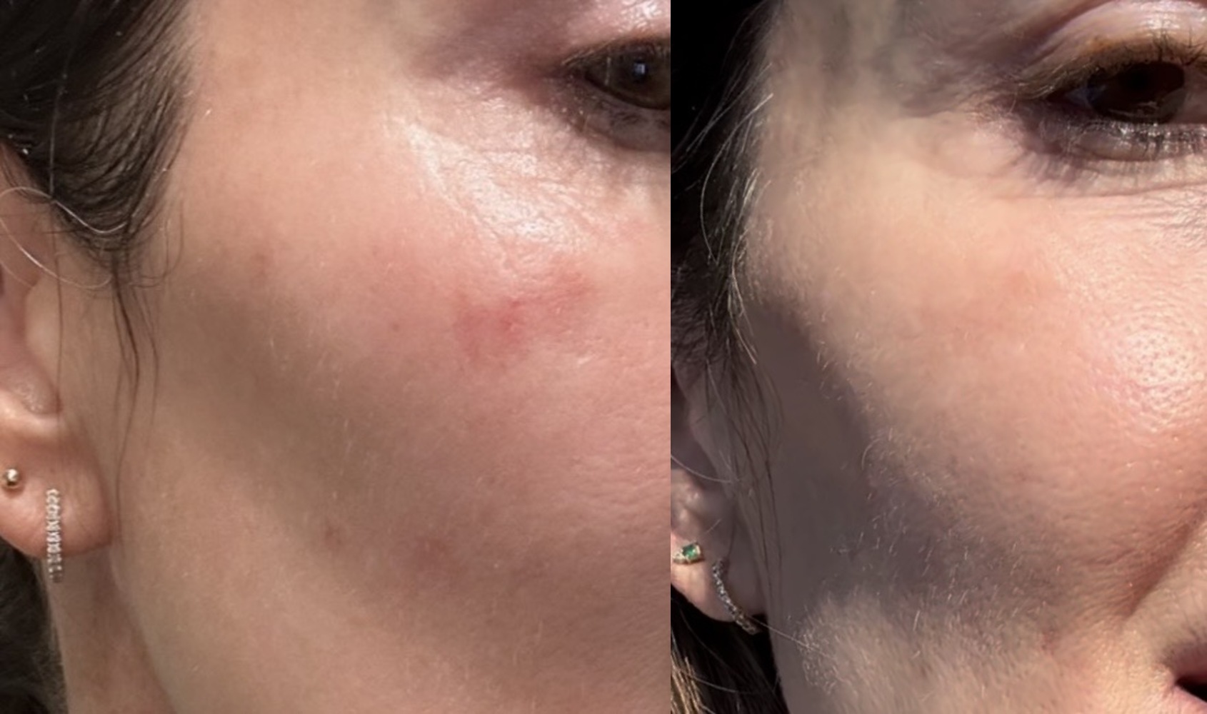 Close-up of a client's cheek area before and after four Micro Glow microneedling treatments.